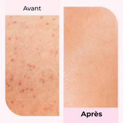 Transformation de la peau avant/après avec LumiSilk - Résultats visibles après utilisation sur peau irritée.