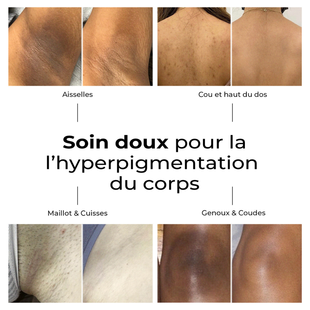 Avant/après avec Lumen Drop – hyperpigmentation du corps : aisselles, cuisses, genoux, haut du dos