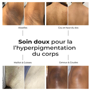Avant/après avec Lumen Drop – hyperpigmentation du corps : aisselles, cuisses, genoux, haut du dos