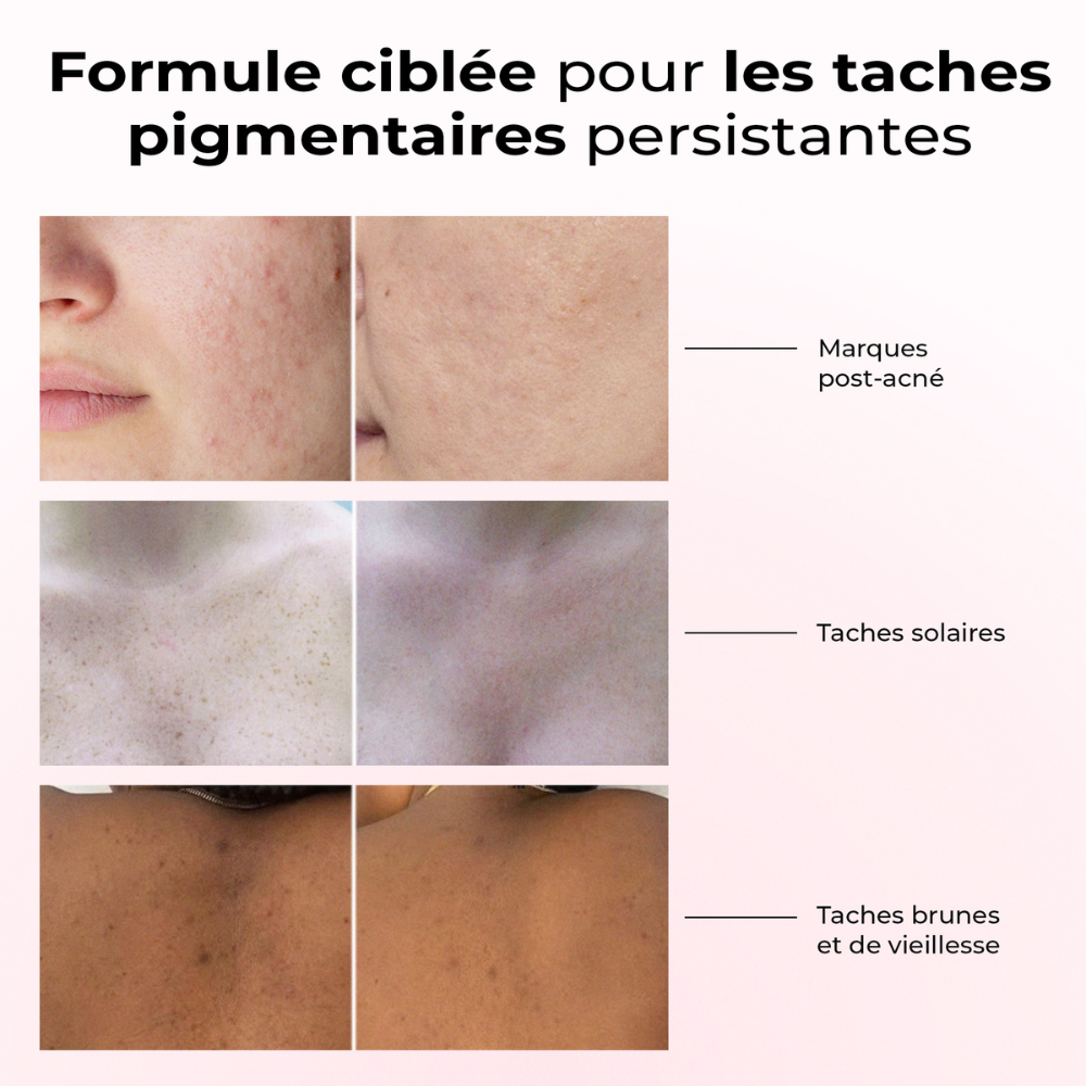 Résultats du sérum Lumen Drop sur les taches pigmentaires : post-acné, soleil, âge – peau visiblement plus claire